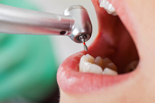 Best Emergency Treatment for Dental Infections or Abscesses in Winder, GA